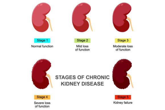 Stages of Chronic Kidney Disease: A Visual Breakdown